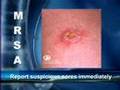 MRSA - Get the Facts