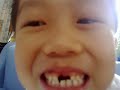 080915 ???-3 incisors 080915 ???-3 incisors