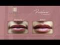 PWTV - Lip Enhancement Using Restylane