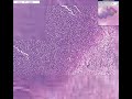 Histopathology Brain, cerebellum --Abscess