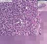 Histopathology Brain, cerebellum --Abscess