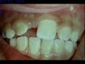 Clinical Pediatric Dentistry; Ectopic eruption due to presence of supernumerary tooth Clinical Pediatric Dentistry; Ectopic eruption due to presence of supernumerary tooth