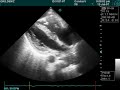 acute pulmonary embolism Pulmonary Embolism