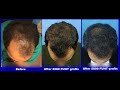5000 + FUHT grafts (Dr. A\