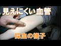 【医療】採血の様子　トアロードクリニック　撮影日2019年11月7日【難症例】