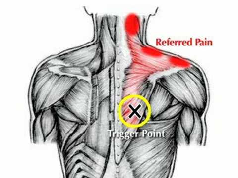 how to relieve rhomboid pain