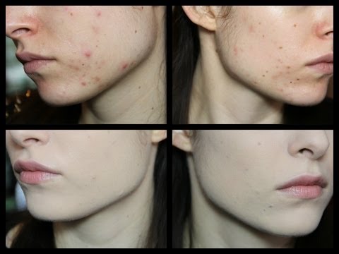 Come copro BRUFOLI/MACCHIE/ACNE LEGGERA | CherylPandemonium