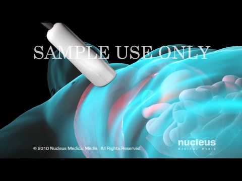 hepatic biopsy - If you like this animation, LIKE us on Facebook: http://www.nucleusinc.com/facebook http://www.nucleusinc.com/medical-animation This medical animation outlin...