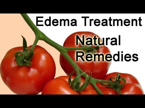 how to cure edema in the legs