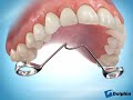 Molar Intrusion Using Mini-Screw