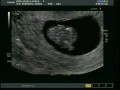 Limer Bean Ultrasound 11 weeks 2 days