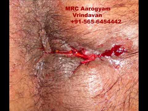 how to treat gnathostomiasis