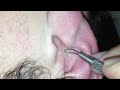 DEEP Yellow blackhead in ear.