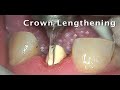PowerLase® All-Tissue Dental Laser: The Complete Laser Operatory™