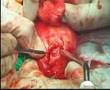 The Krishnamurti Operation for Peyronie's Disease (6 of 7)