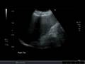 Liver coronal