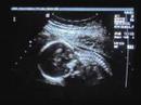 Baby Beaudoin Ultrasound
