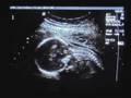 Baby Beaudoin Ultrasound