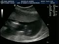 Ultrassom morfol�gico segundo trimestre