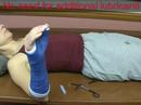 application of a fiberglass short ...