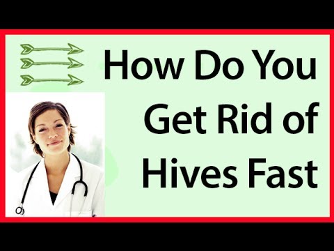 how to relieve hives fast
