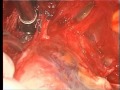 Radical Retropubic Prostatectomy - Open Technique