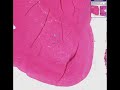 Histopathology Intestine--Meconium obstruction with necrosis