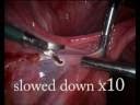 videos de Principles of Electrosurgery 2008.wmv