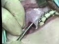 Cirugia Ortognatica Wassmund modificada