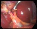 Routine Lap Chole/cholangiogram