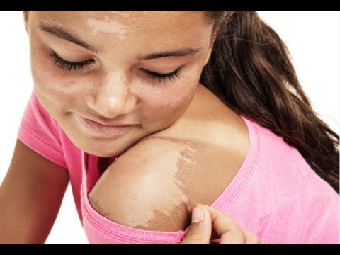 how to get rid of skin that is peeling