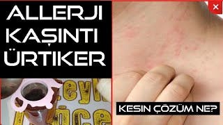 Alerji kaşıntı ve ürtikere kesin çözüm Aler