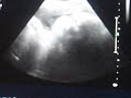 Ultrasound at 39 Weeks