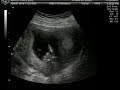 13 week 4 day Ultrasound...IT'S A....!!