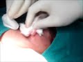 Surgery On Large Infected Sebaceous Cyst Neck
