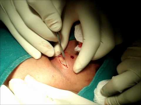 how to unclog sebaceous cyst