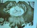Pons (Level of deep cerebellar nuclei)