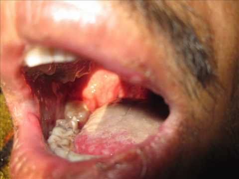 how to relieve oral thrush