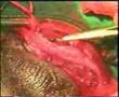 The Krishnamurti Operation for Peyronie's Disease (7 of 7)