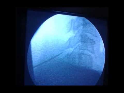how to perform epidural steroid injection