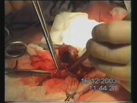Colon Surgery - Resection of Colon Transversum for Colon Cancer with Stage IIIA (T3N1M0)