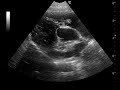 Video - Tricuspid Valve Mass