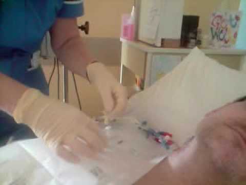 how to remove central line