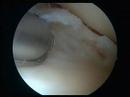 Meniscus OP Surgery