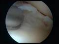 Meniscus OP Surgery