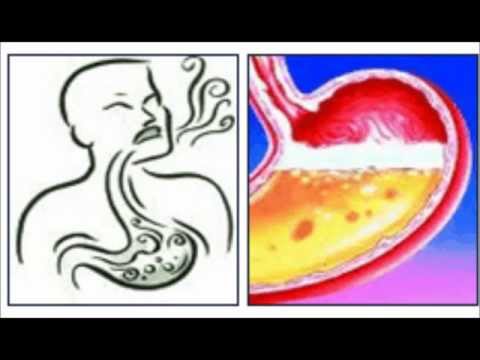 how to cure h pylori naturally