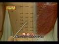 Cupping - Chinese Massage DVD  