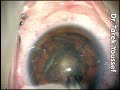 Routine Phacoemulsification and Tecnis Acrylic 9003Z IOL implant using the chopping technique with whitstar AMO machine. J-cannula is used for cortical cleanup.