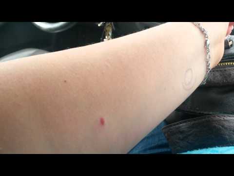 how to test tb skin test