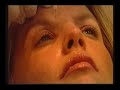 RTE TV interviews Dr. Treacy about Chemical Brow Lift